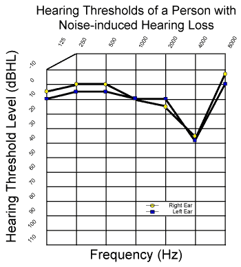 Decibel Levels And Hearing Loss Chart