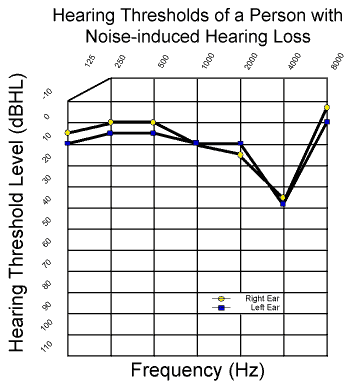 Hearing Loss Frequency Chart